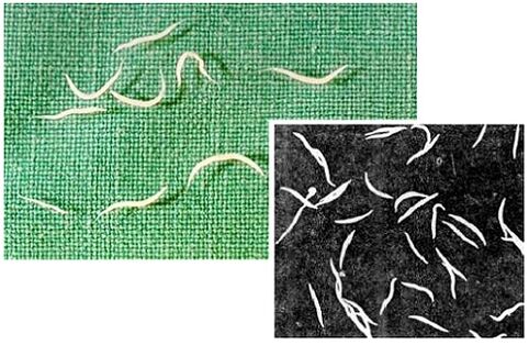 Pinworms dal corpo umano