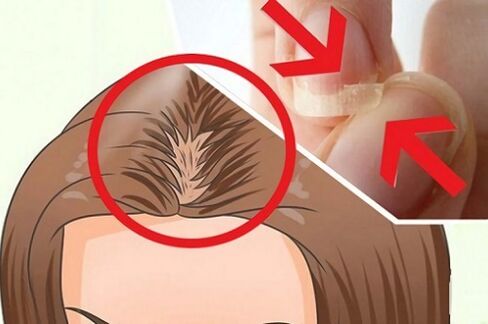 Problemi ai capelli e alle unghie con i parassiti