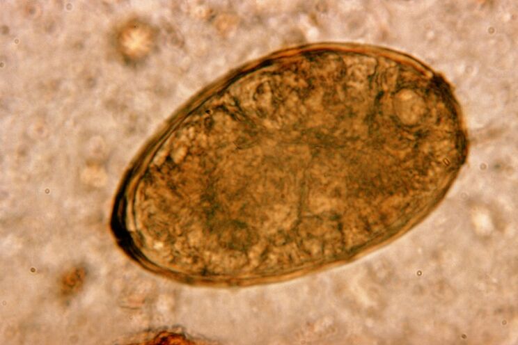 Trematodi polmonari negli esseri umani